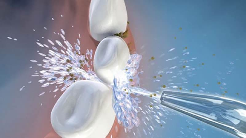 irrigador oral